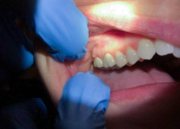 Best Emergency Treatment for Toothache in Myerstown, PA